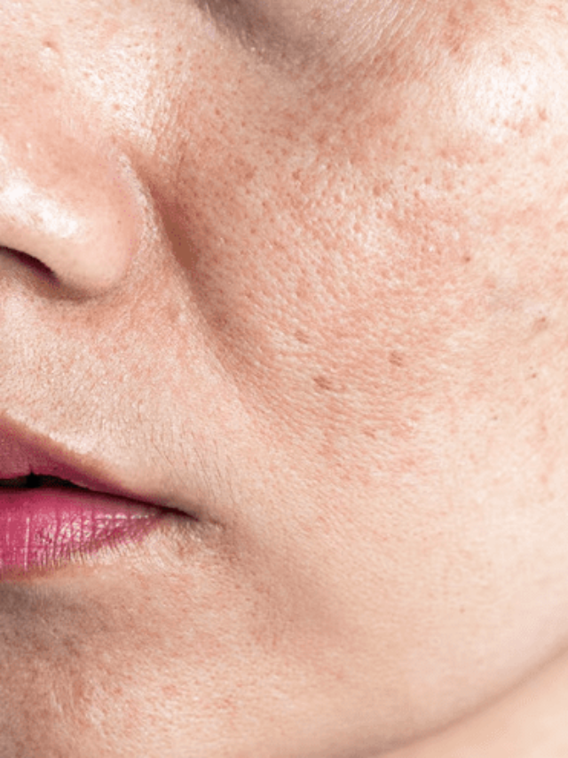 Melasma: O Que É e Por Que Ele Aparece?