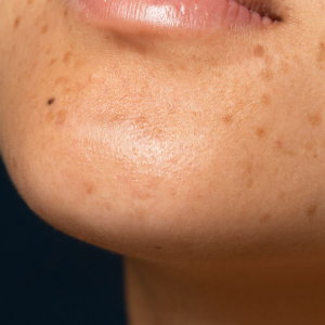 Manchas no Rosto: Como Clarear a Pele Rápido com Ingredientes Naturais